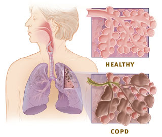 Normal Lung vs COPD