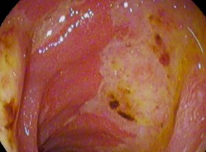 Duodenal Lesion